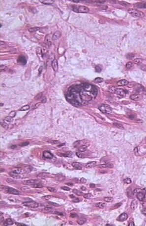 Imagen de Tumor mesenquimatoso del tracto gastrointestinal, variante GILT (Gastrointestinal leiomiomatous tumor). Presentacin de un caso.