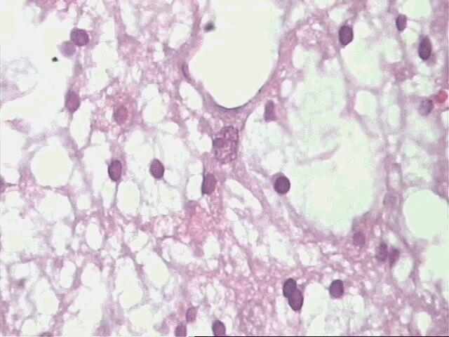 Imagen de Tumores Glioneuronales del Sistema Nervioso Central. A propósito de 3 casos.