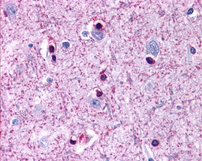 Imagen de Inmunorreactividad para ADRA-1A en el SNC y Oligodendrogliomas (resultados preliminares).