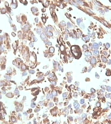 Imagen de Tumor mesenquimatoso del tracto gastrointestinal, variante GILT (Gastrointestinal leiomiomatous tumor). Presentacin de un caso.