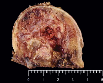 Imagen de Condrosarcoma de clulas claras: Presentacin de un caso con dos focos sncronos bilaterales en cabezas femorales.