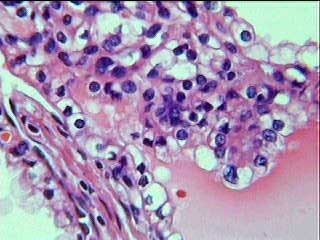 Imagen de Multilocular cystic renal cell carcinoma (MCRCC): A benign tumor entity? Multi-institutional report of 23 cases from Brazil, Spain, Japan, and Argentina.