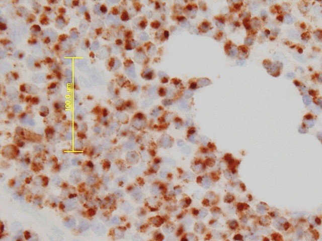 Fig. 24: Linfoma T/NK testicular. Granzime B - <div style=