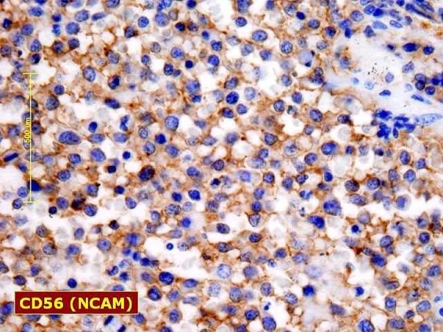 Fig. 25: Linfoma Testicular. T/NK. CD56 - <div style=