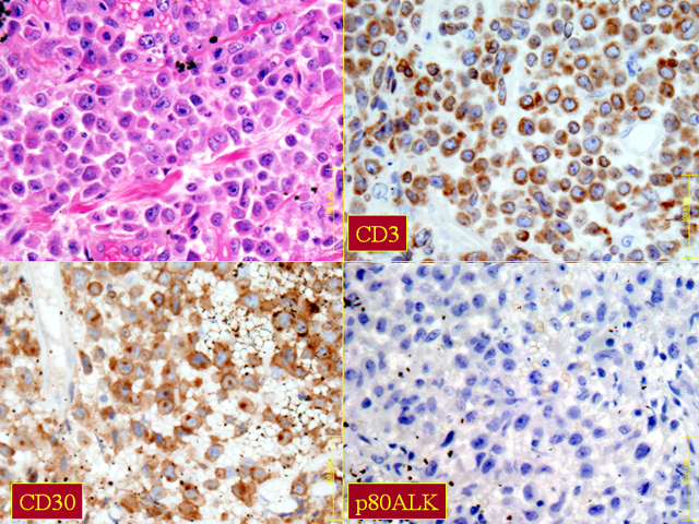 Fig. 22: ALCL. - <div style=