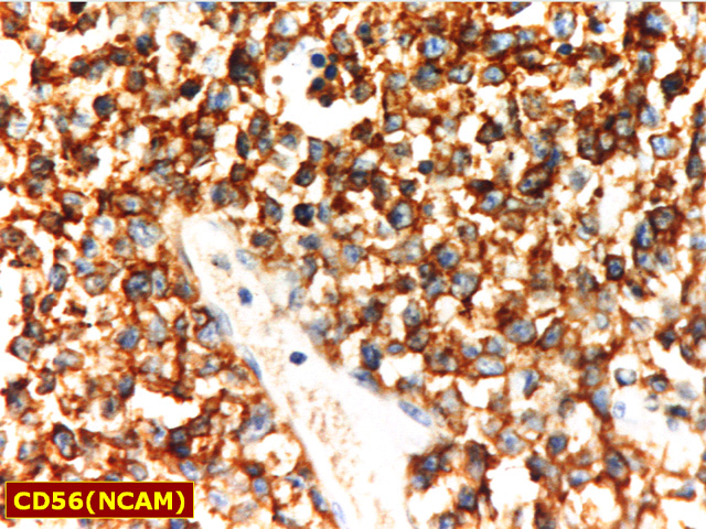 Fig. 5: Linfoma T/NK Nasal.  CD56 - <div style=