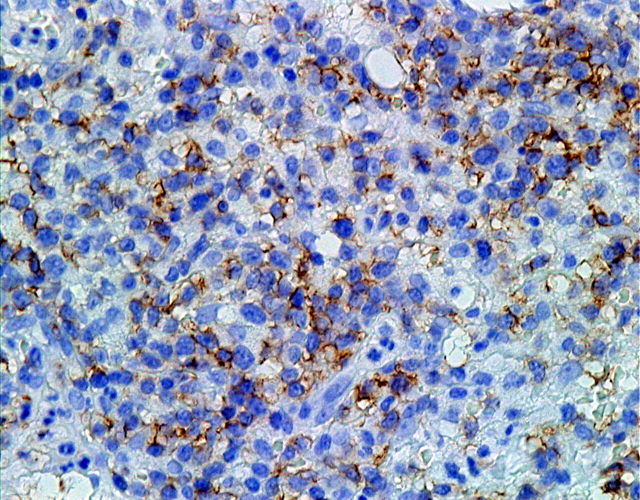 Fig. 10: Linfoma Nasal T/NK. CD56 - <div style=