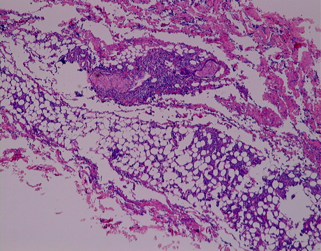 Fig. 16: Linfoma T/NK, en tejidos blandos. H-E - <div style=