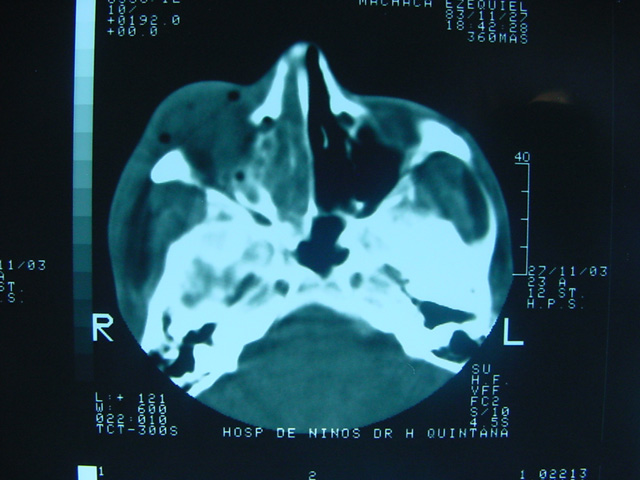 Fig. 1: Linfoma Nasal NK/T - <div style=