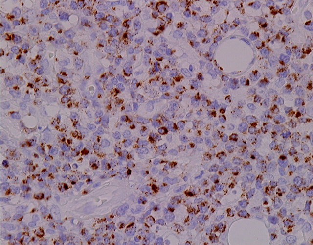 Fig. 12: Linfoma T/NK, Extraganglionar. TIA-1 - <div style=