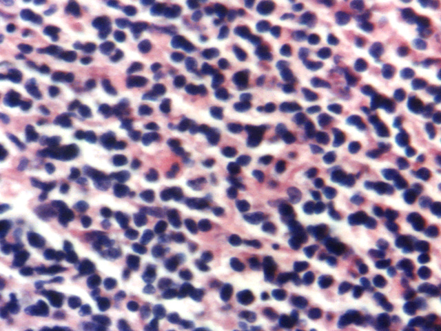 Fig. 3: Infiltrado linfoide medular. H-E - <div style=