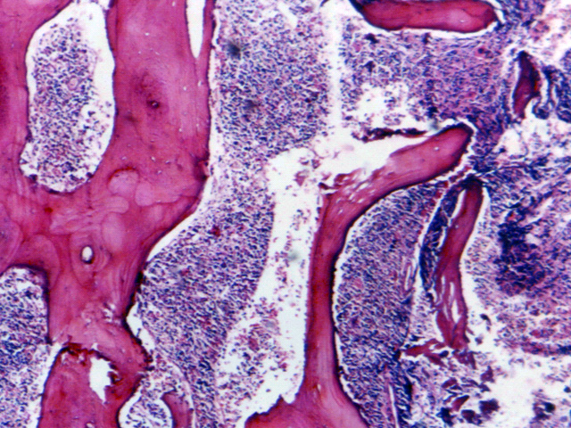 Fig. 1: Biopsia medular. - <div style=