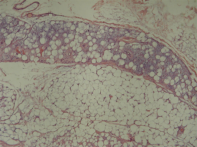 Mixofibrolipoma dendrtico: HE, X4 - <div style=