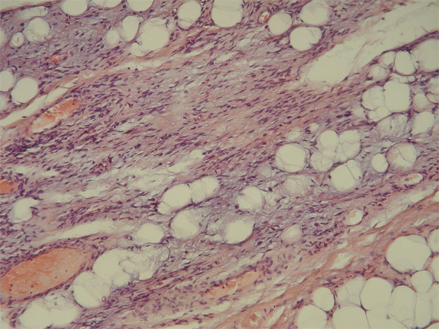 Mixofibrolipoma dendrtico: HE, X20 - <div style=