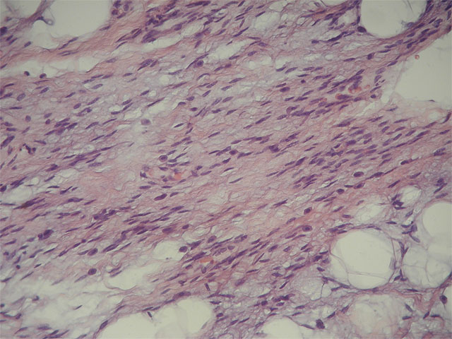 Mixofibrolipoma dendrtico: HE, X40 - <div style=