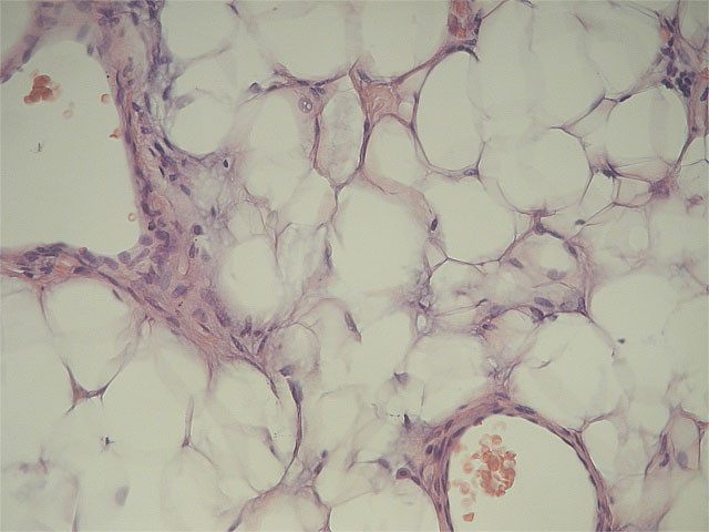 Mixofibrolipoma dendrtico: HE,X40 - <div style=