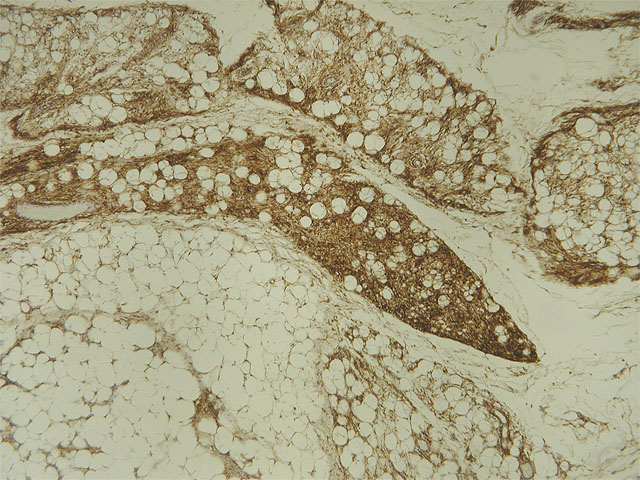 Mixofibrolipoma dendrtico: CD34 - <div style=