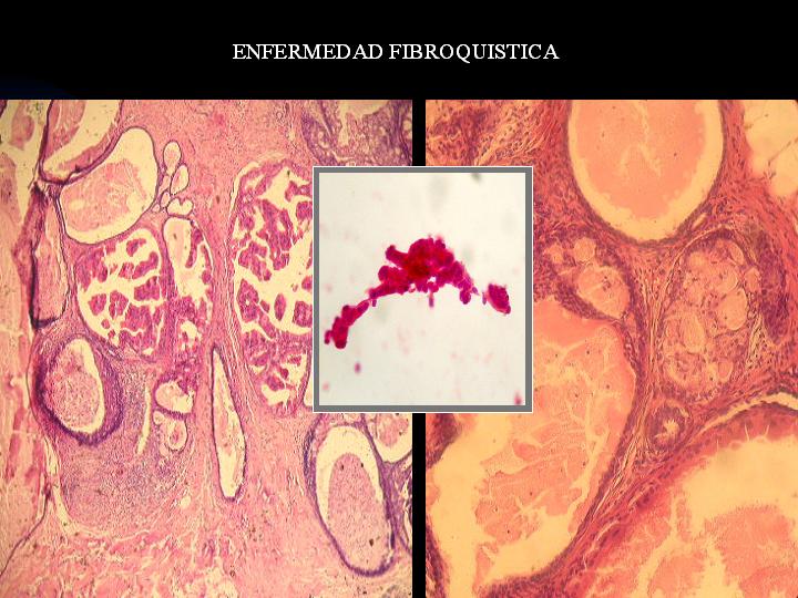 Condicion Fibroquistica Mamaria Pdf