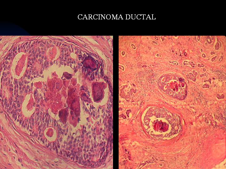 CARCINOMA DUCTAL - <div style=