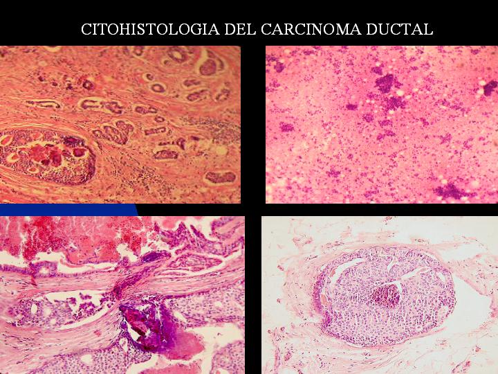 CITOHISTOLOGIA DEL CARCINOMA DUCTAL - <div style=