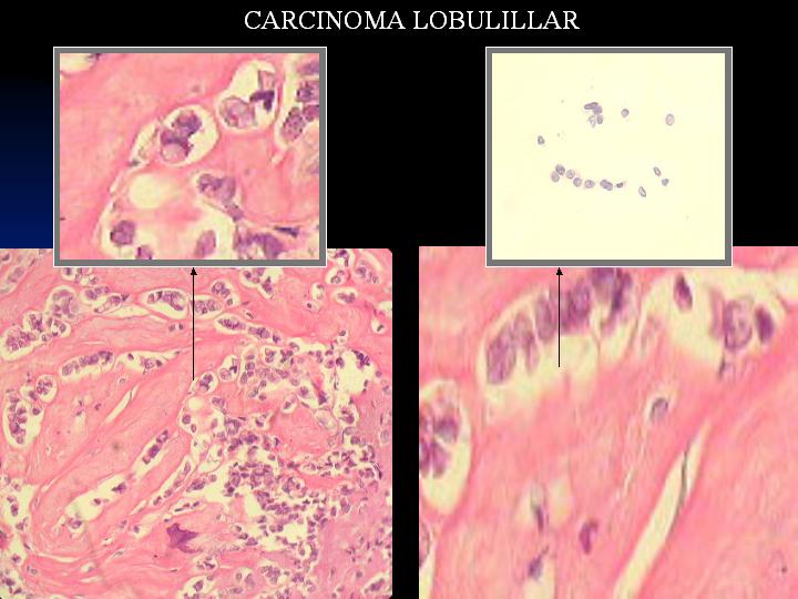 CARCINOMA  INTRAQUISTICO - <div style=