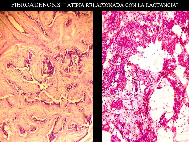 ATIPIA RELACIONADA CON LA LACTANCIA - <div style=