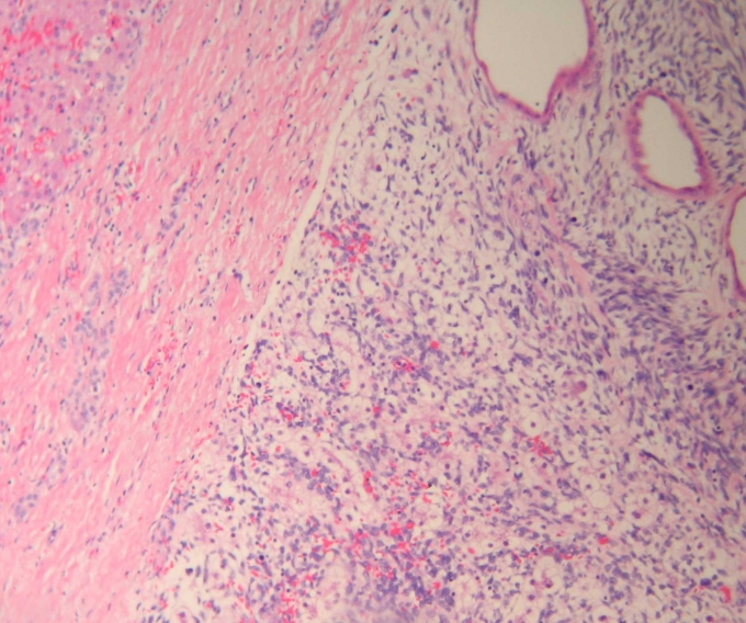 Sarcoma fusocelular mixoide atrapando hepatocitos - <div style=