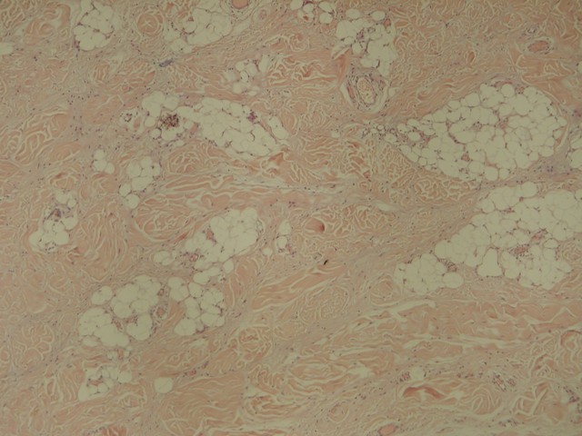 ANGIOMIOFIBROBLASTOMA LIKE VARIANTE LIPOMATOSA - <div style=