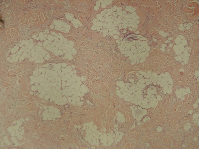 ANGIOMIOFIBROBLASTOMA-LIKE VARIANTE LIPOMATOSA - <div style=