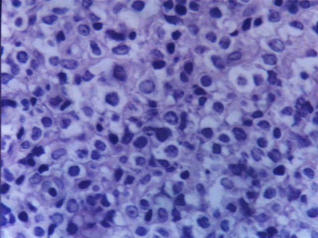 Fig.23: Linfoma Mediastinal B (Tímico). H-E - <div style=