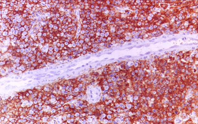 Fig.17: Linfoma Plasmboblastico de la cavidad oral - <div style=