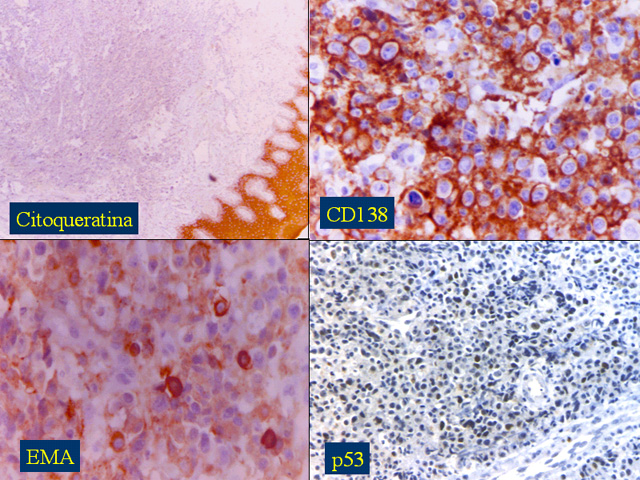 Fig. 18: Linfoma Plasmoblastico de la cavidad oral - <div style=