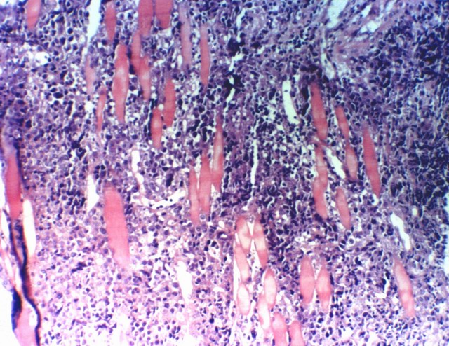 Fig. 11: Linfoma Plasmoblastico de la cavidad oral - <div style=