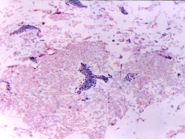 Fig.19: Pleural Efussion Lymphoma (PEL) - <div style=