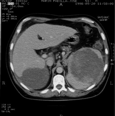 TAC abdominal - <div style=