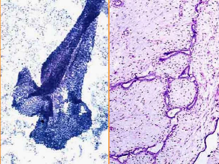 Fibroadenoma. Citologa-2 - <div style=