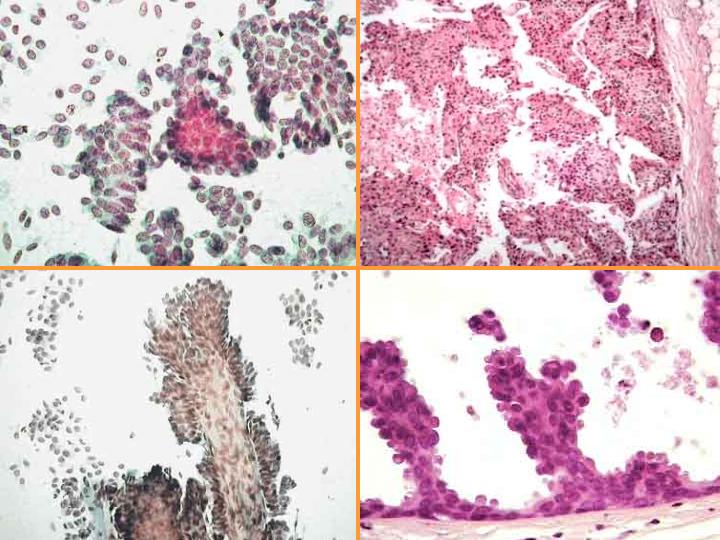 Carcinoma Papilar - <div style=