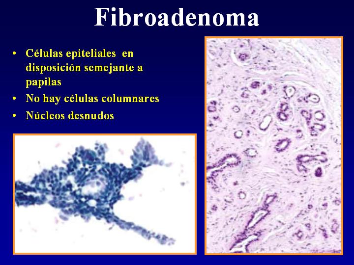Fibroadenoma* - <div style=
