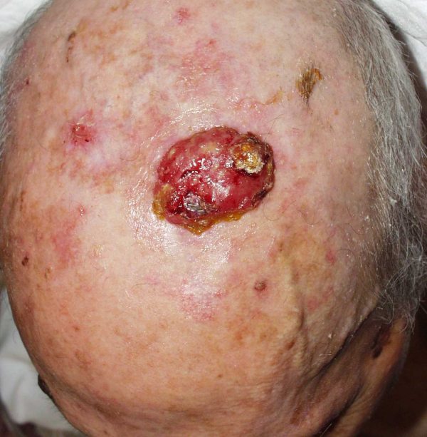 Figura 2: Tumor en el cuero cabelludo (paciente 2)
