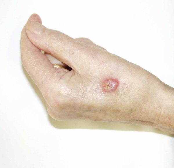 Figura 3: Nódulo en el dorso de la mano (paciente 3)