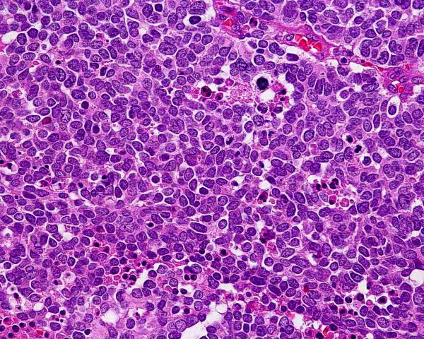 Figura 7: HE 400x. Las células son pequeñas y monomorfas, con núcleo vesicular e hipercromático  con cromatina finamente granular y escaso citoplasma.