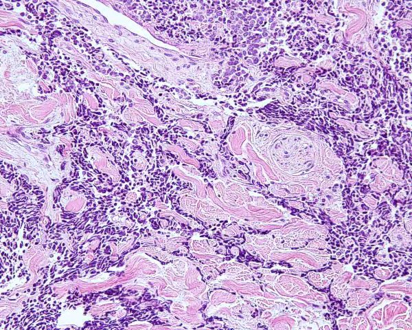 Figura 15: HE 200x. Patrón de célula pequeña. Grupos intradérmicos de células pequeñas e hipercromáticas, similares al carcinoma de células pequeñas de pulmón.