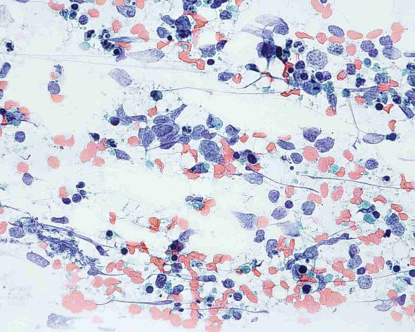 Figura 23: Papanicolaou 400x. Las células son de tamaño pequeño-intermedio con núcleo con cromatina finamente granular. Es habitual  la apoptosis.