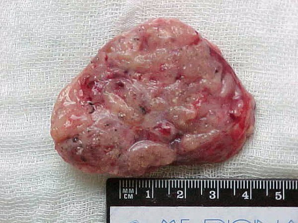 Mediastinal mass - <div style=