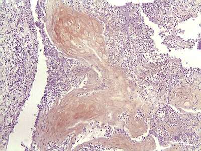 Carcinoma Espinocelular - <div style=