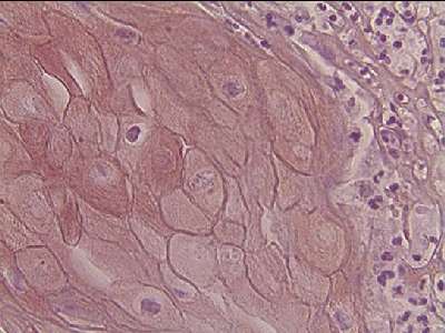 Carcinoma Espinocelular 3 - <div style=