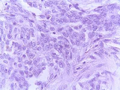 Adenocarcinoma Tubular - <div style=