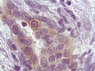 Adenocarcinoma Tubular 3 - <div style=