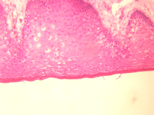 Coilocitos en lesin oral - <div style=