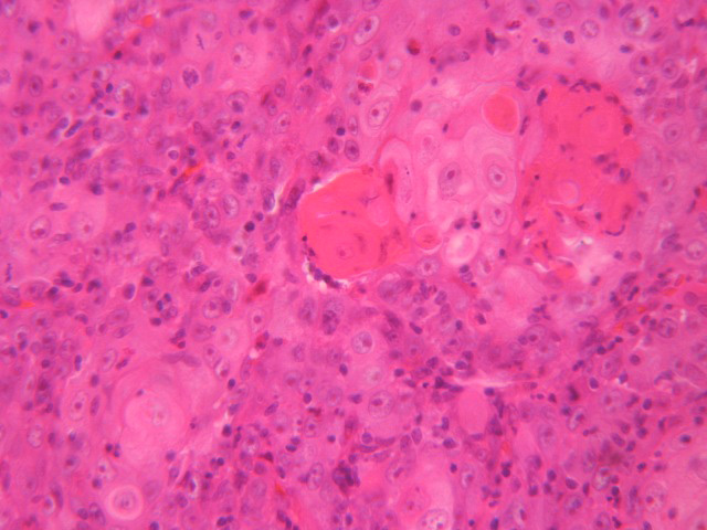 Carcinoma Epidermoide - <div style=